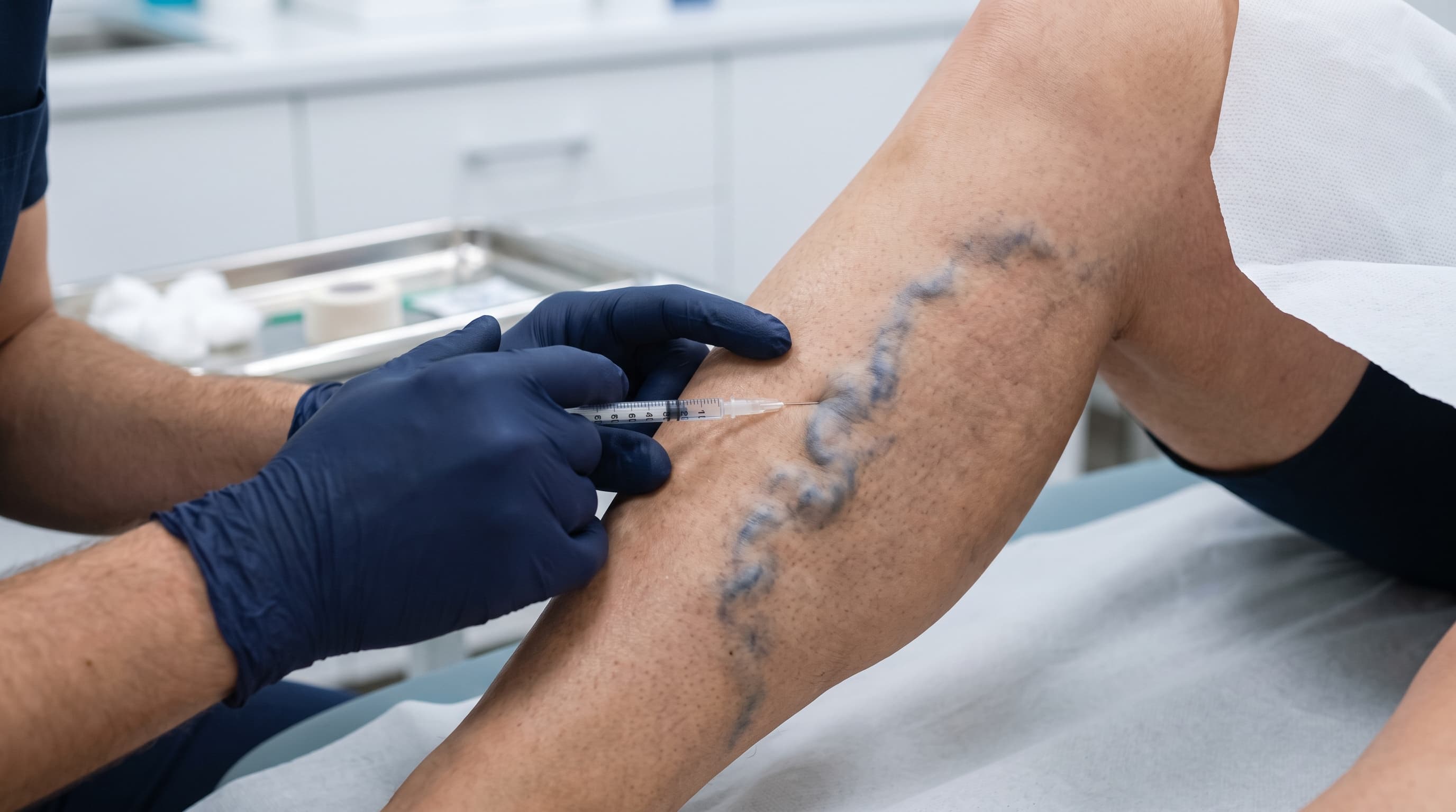 Escleroterapia
